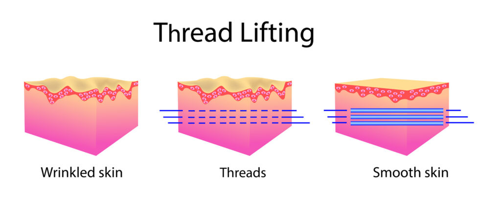 Thread Lifting